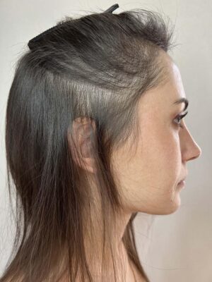 Perte de densité capillaire avant tricopigmentation chez une femme à Bordeaux – zone clairsemée visible