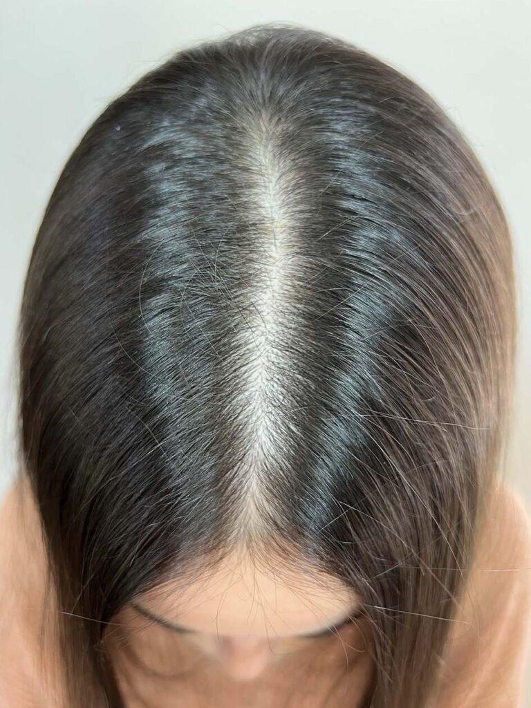 avant alopécie féminine perte de cheveux pour apporter densité capillaire