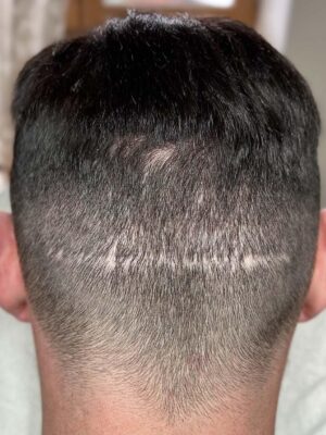 Homme avant tricopigmentation avec cicatrice FUT suite à une greffe de cheveux à Bordeaux – perte de densité visible