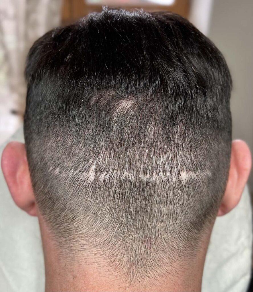 Cicatrice linéaire après greffe de cheveux FUT