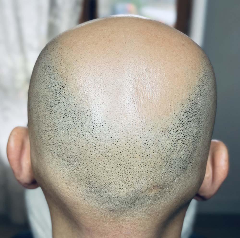homme chauve calvitie