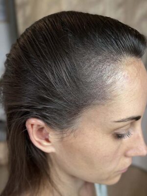 Densité capillaire après tricopigmentation chez une femme à Bordeaux – résultat naturel et harmonieux