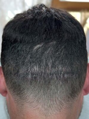 Homme après tricopigmentation pour cicatrice FUT à Bordeaux – densité capillaire restaurée et cicatrice masquée