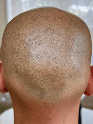Homme après tricopigmentation pour calvitie de la couronne à Bordeaux – zone clairsemée camouflée et densité restaurée