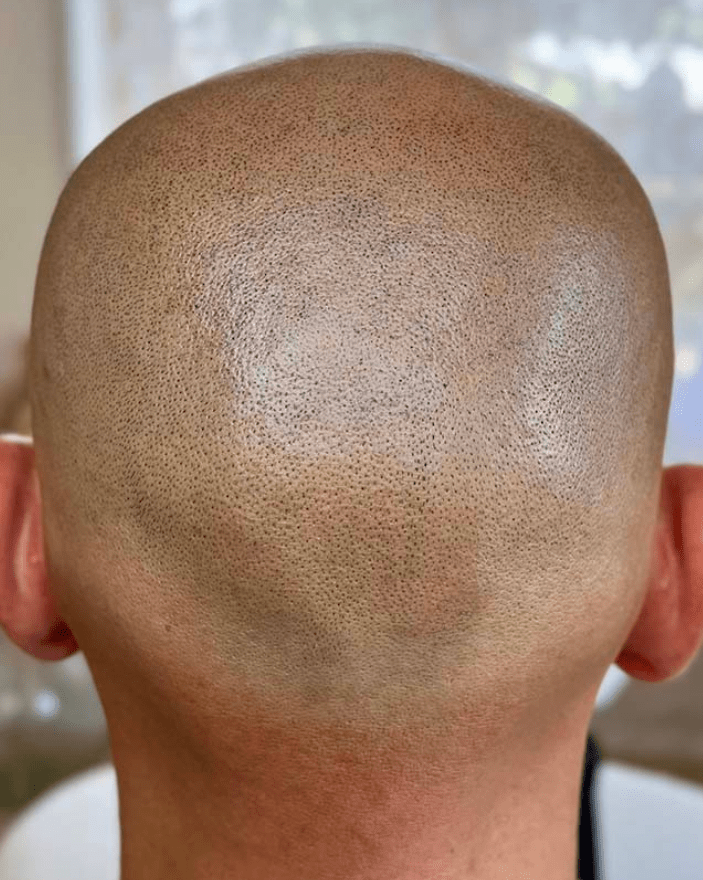 résultat après dermopigmentation capillaire sur calvitie