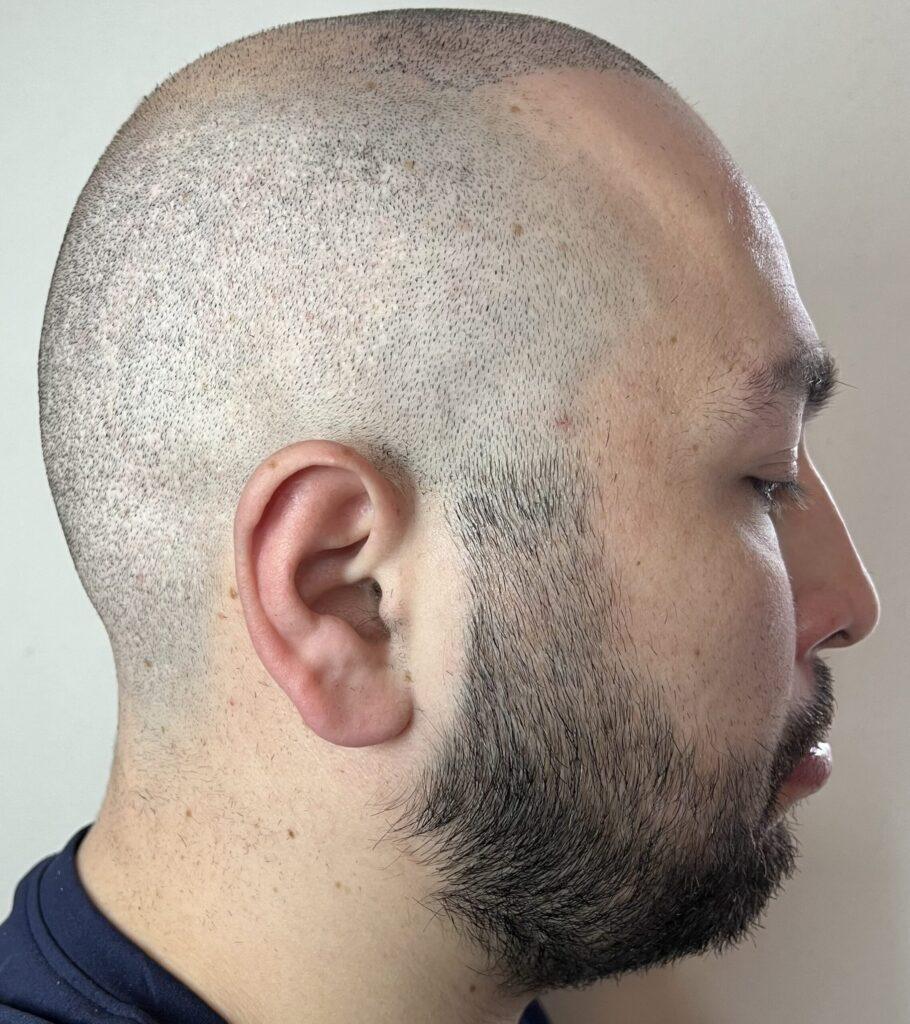 avant camouflage de cicatrices greffe de cheveux ratée turquie