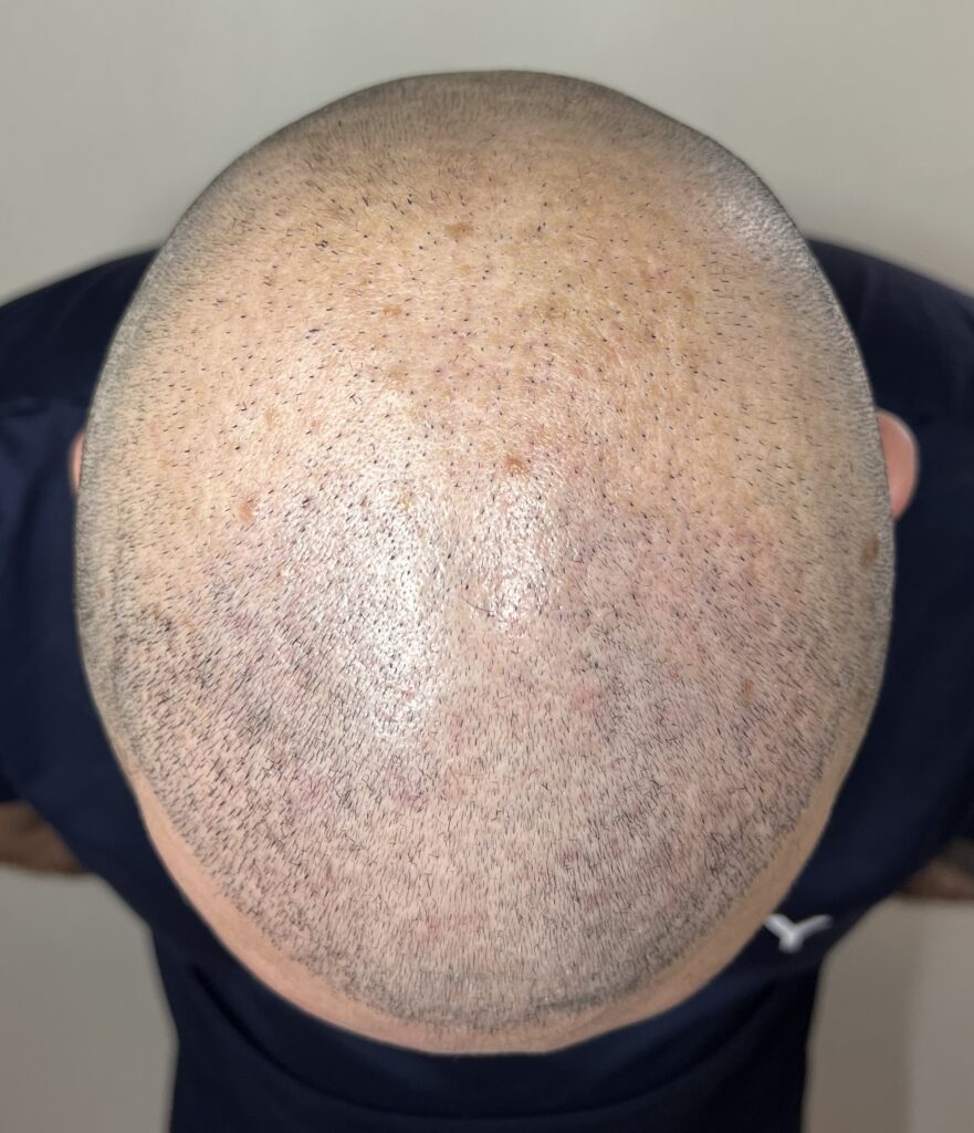 avant dermopigmentation capillaire greffe de cheveux turquie ratée