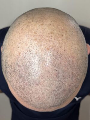 crâne rasé avant dermopigmentation capillaire