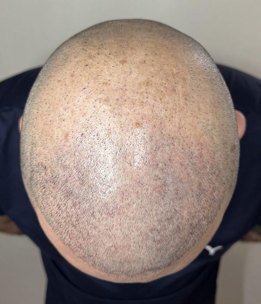avant dermopigmentation capillaire greffe de cheveux turquie ratée