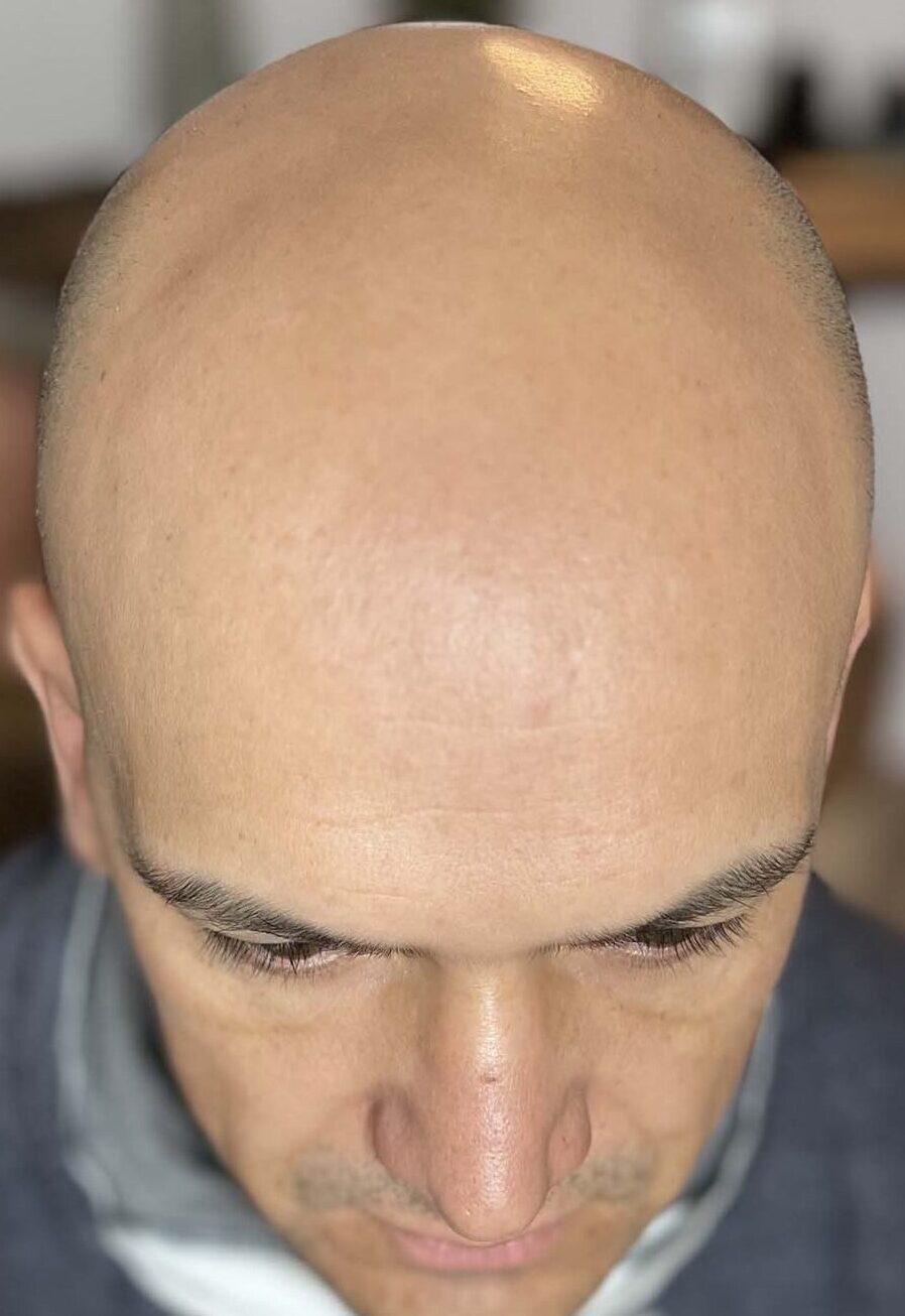 cuir chevelu chauve avant tricopigmentation