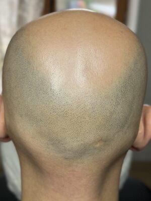 homme avec une calvitie avant la tricopigmentation