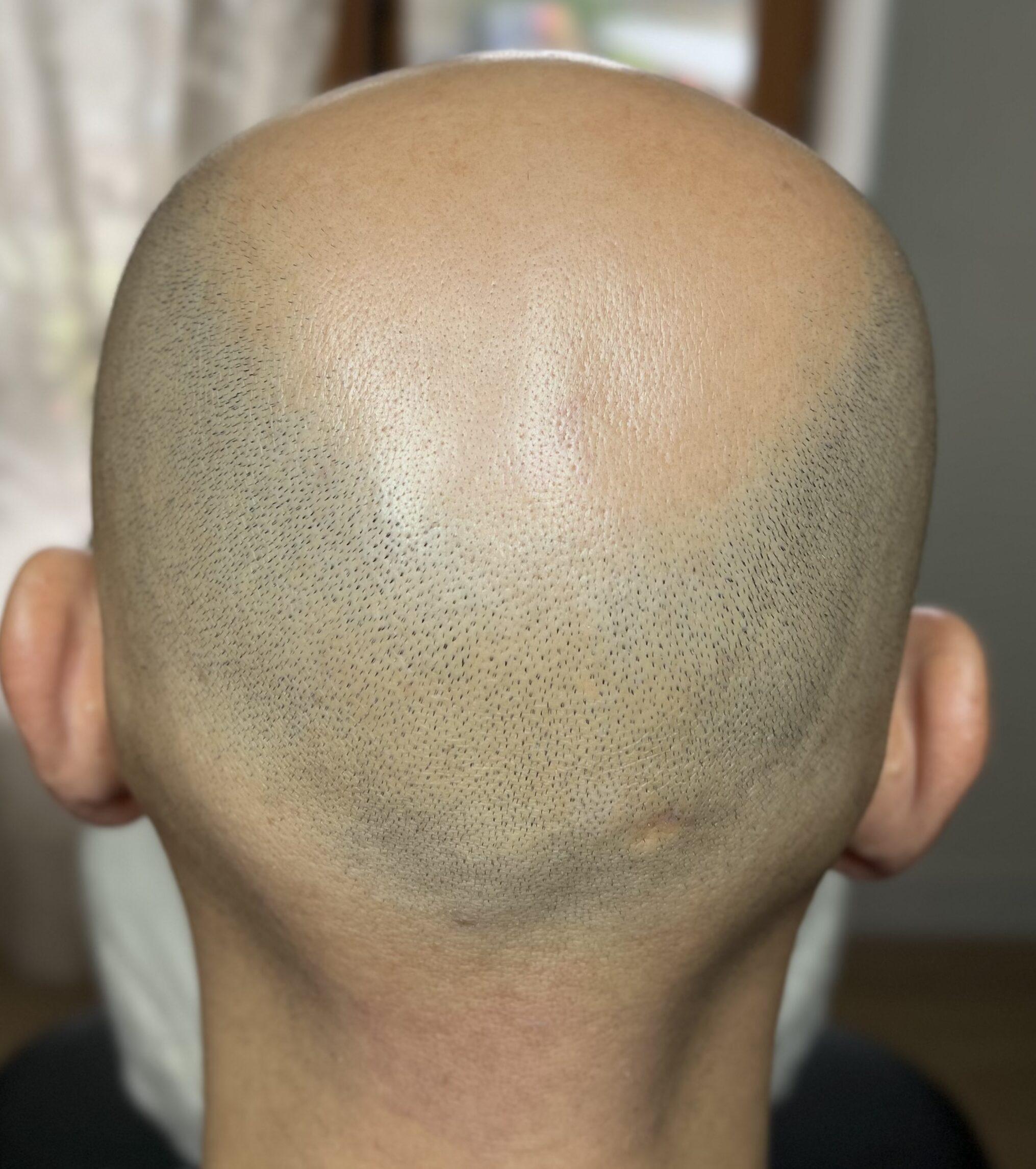 avant tricopigmentation sur homme chauve