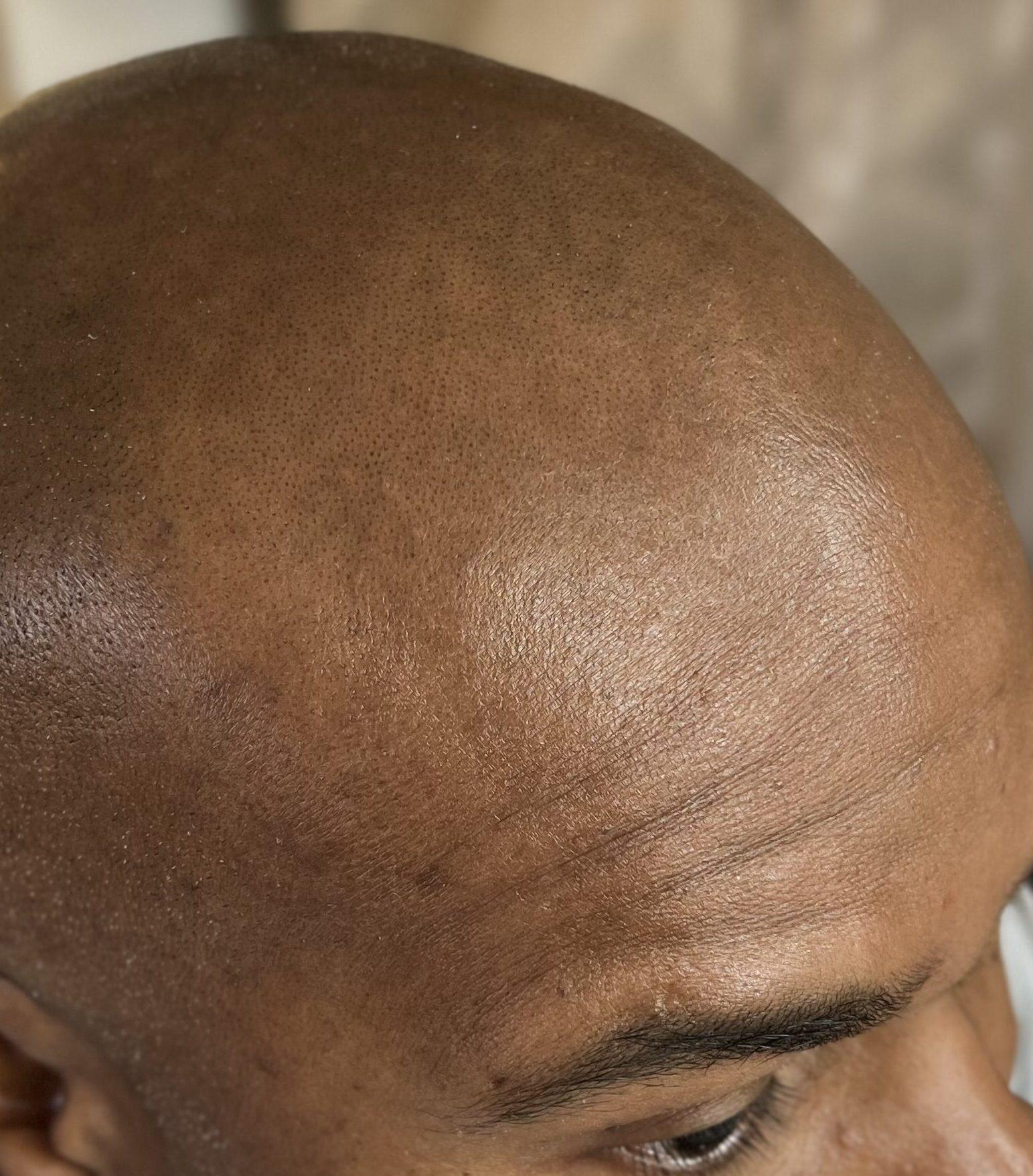 avant tricopigmentation sur peau métisse