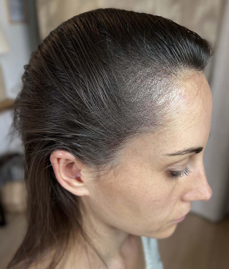 Résultat de densification capillaire femme après tricopigmentation