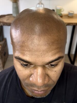 Homme après tricopigmentation pour calvitie à Bordeaux – densité capillaire restaurée et ligne frontale naturelle