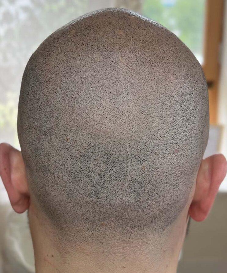 Camouflage de cicatrice greffe de cheveux en tricopigmentation