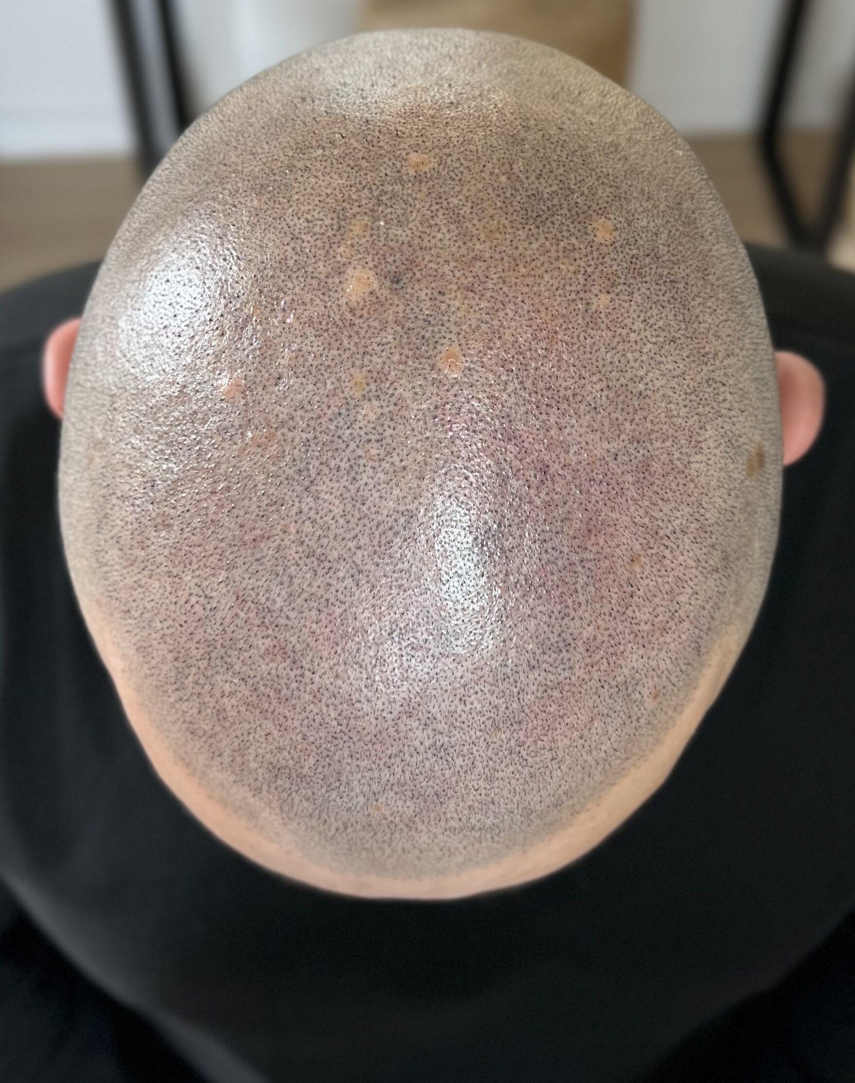 tricopigmentation réparatrice après greffe capillaire en turquie