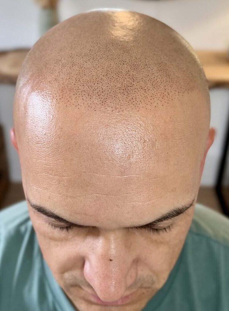effet rasé naturel après tricopigmentation sur calvitie totale
