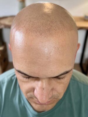 résultat après la tricopigmentation effet rasé