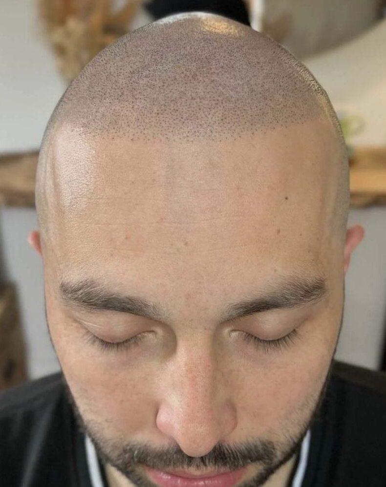avancement ligne frontale correction post greffe de cheveux