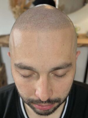 Homme après tricopigmentation pour ligne frontale avancée à Bordeaux – densité et harmonie restaurées