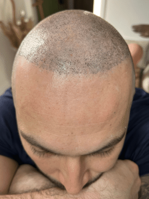 Homme avant tricopigmentation avec ligne frontale reculée suite à une greffe ratée à Bordeaux – perte de densité visible