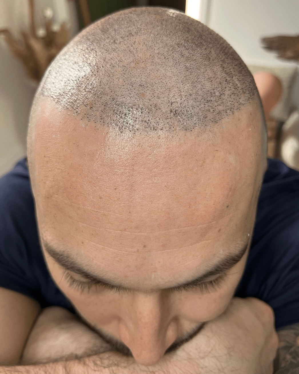 avant tricopigmentation suite à une greffe de cheveux ratée