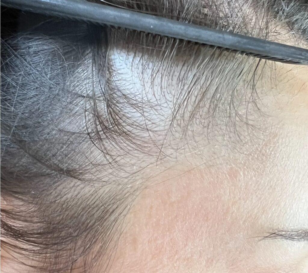 Avant et après tricopigmentation densifiante sur cheveux fins