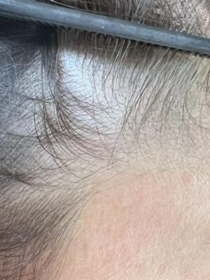 Perte de densité capillaire avant tricopigmentation chez une femme à Bordeaux – zone clairsemée visible