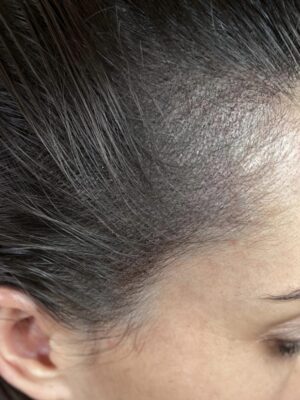 Densité capillaire après tricopigmentation chez une femme à Bordeaux – résultat naturel et harmonieux