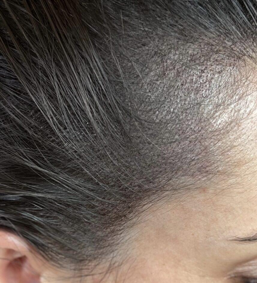 Avant et après tricopigmentation densifiante sur cheveux fins