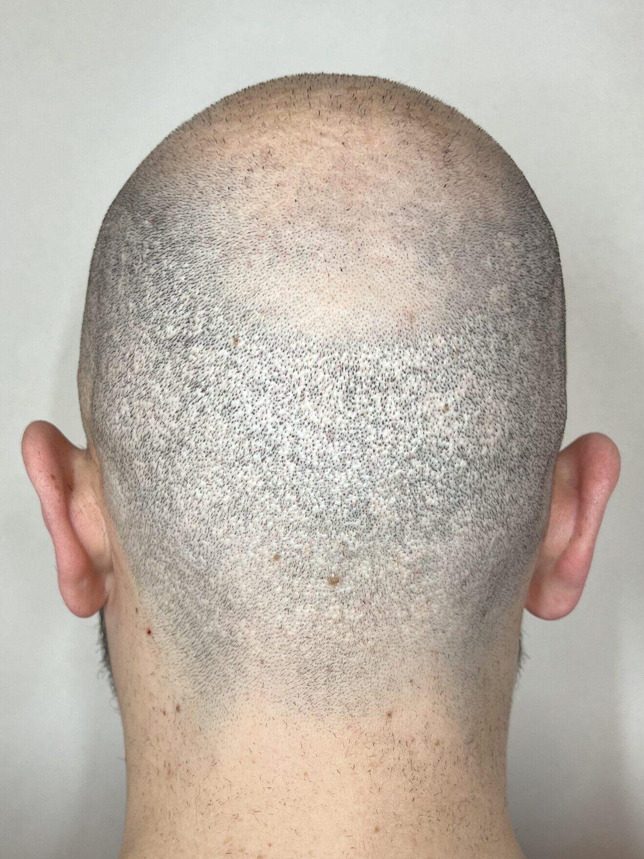 cicatrice post greffe turquie