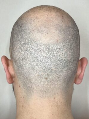 Perte de densité capillaire et cicatrices après greffe FUE chez un homme à Bordeaux – avant tricopigmentation