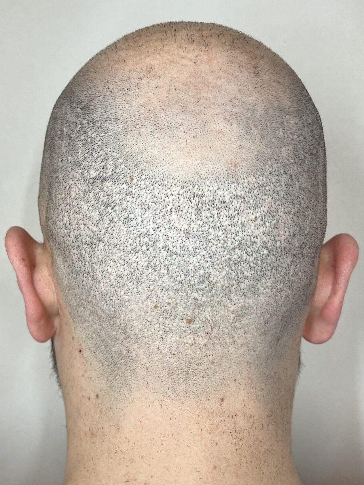 cicatrice post greffe de cheveux en turquie