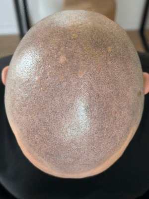Homme après densification capillaire sur le dessus du crâne suite à une greffe ratée à Bordeaux – effet naturel après tricopigmentation