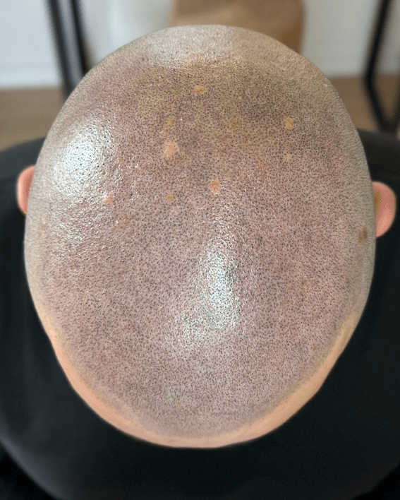 après tricopigmentation post greffe capillaire
