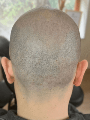 Homme après tricopigmentation suite à cicatrices FUE à Bordeaux – densité capillaire restaurée