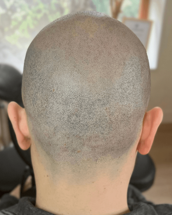 résultat tricopigmentation pour cacher des cicatrices post greffe capillaire