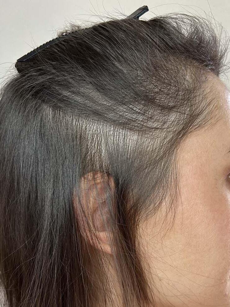 Photo avant une séance de tricopigmentation réalisée à Bordeaux sur une femme présentant une perte de densité capillaire. La zone traitée montre des cheveux clairsemés et fins qui seront densifiés grâce à une technique de dermopigmentation naturelle et progressive. nouvelle aquitaine gironde pessac mérignac talence bègles