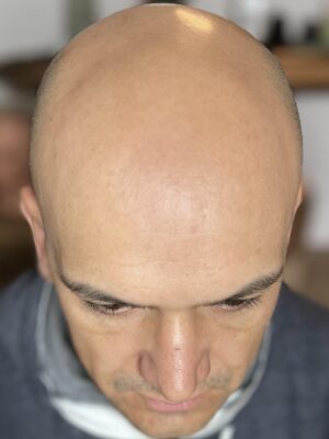 Calvitie avant tricopigmentation chez un homme à Bordeaux – perte de densité visible sur le dessus du crâne