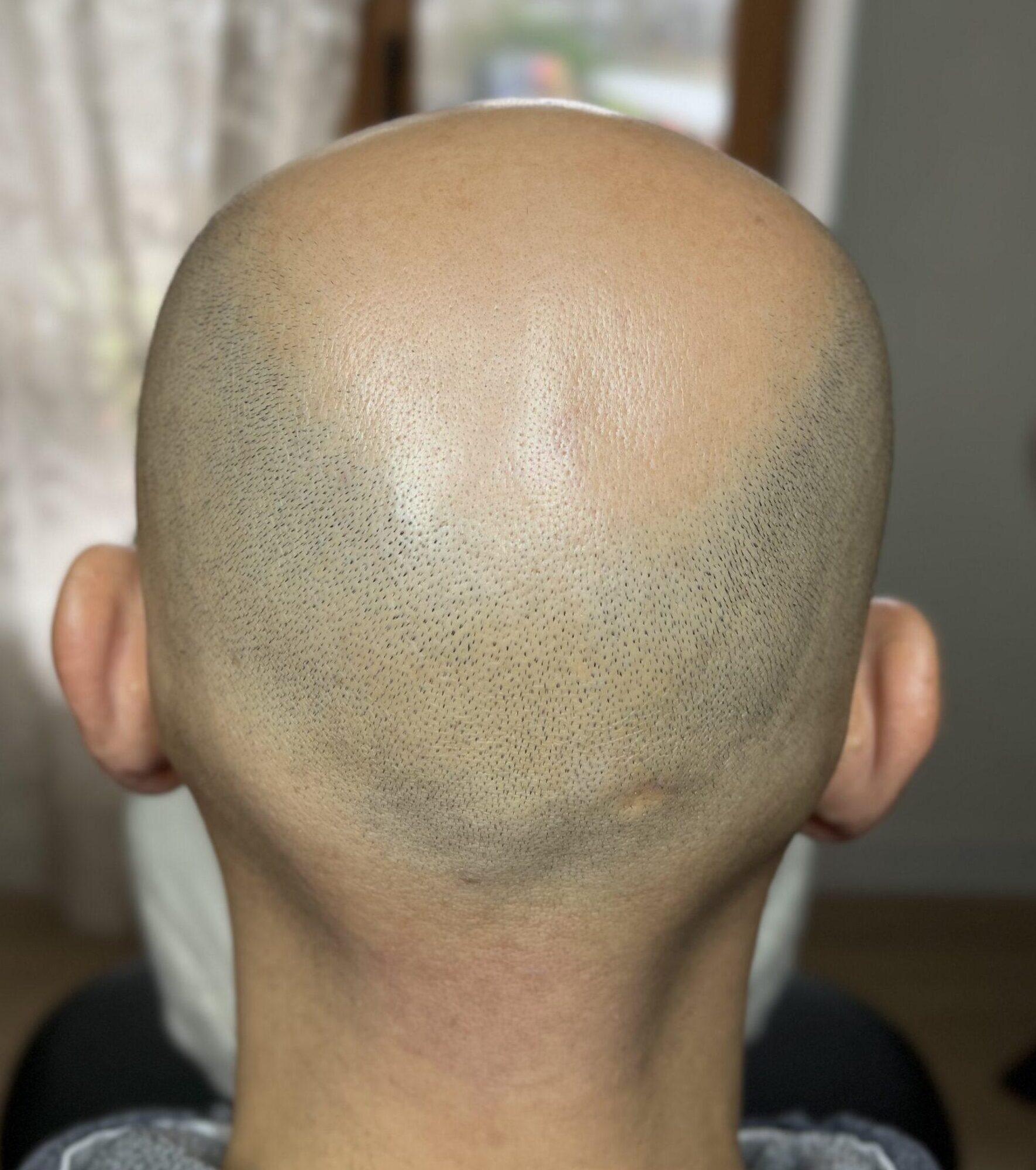 Photo avant tricopigmentation montrant une calvitie marquée au niveau de la couronne. La perte de densité est visible avec une zone clairsemée sur le vertex, typique de l’alopécie androgénétique. Cette zone sera ensuite travaillée en tricopigmentation pour recréer un effet de densité naturel et harmonieux. nouvelle aquitaine gironde mérignac pessac talence bègles