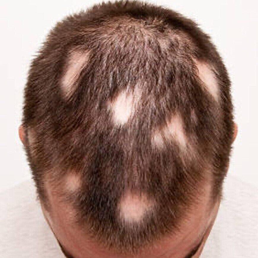 Photo avant une séance de tricopigmentation à Bordeaux sur une personne présentant une pelade, avec des zones de cheveux clairsemées ou absentes. La zone traitée sera densifiée et redessinée grâce à la tricopigmentation, pour un rendu naturel et harmonieux. nouvelle aquitaine gironde pessac mérignac talence bègles