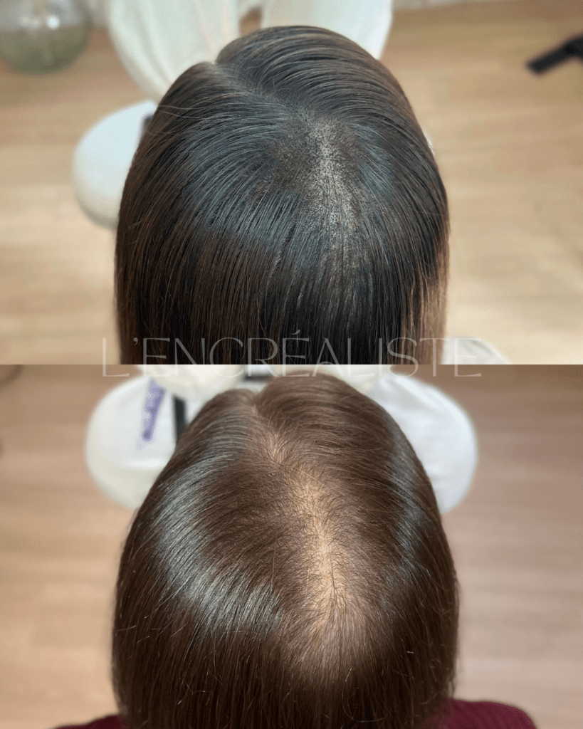 Photo avant après une tricopigmentation réalisée à Bordeaux sur une femme pour restaurer la densité capillaire. La zone traitée apparaît plus uniforme, avec un effet naturel qui imite parfaitement le cheveux et redonne confiance et harmonie. nouvelle aquitaine gironde mérignac talence pessac bègles