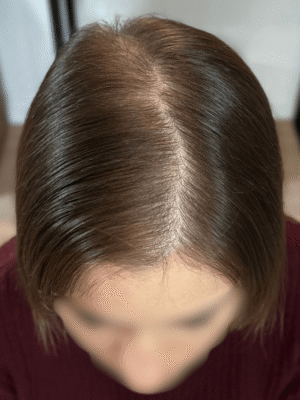 Perte de densité capillaire avant tricopigmentation chez une femme à Bordeaux – zone clairsemée visible