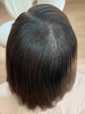 Densité capillaire après tricopigmentation chez une femme à Bordeaux – résultat naturel et harmonieux