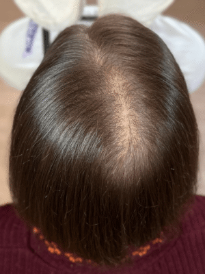 Perte de densité capillaire avant tricopigmentation chez une femme à Bordeaux – zone clairsemée visible