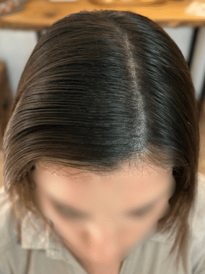 Densité capillaire après tricopigmentation chez une femme à Bordeaux – résultat naturel et harmonieux